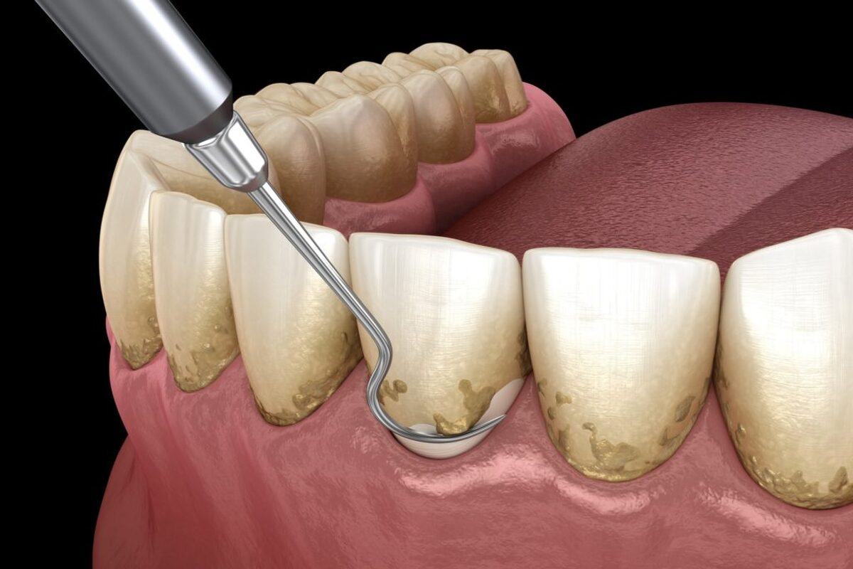 .//wp-content/uploads/2023/10/Periodontal-Treatment1200x800.jpg